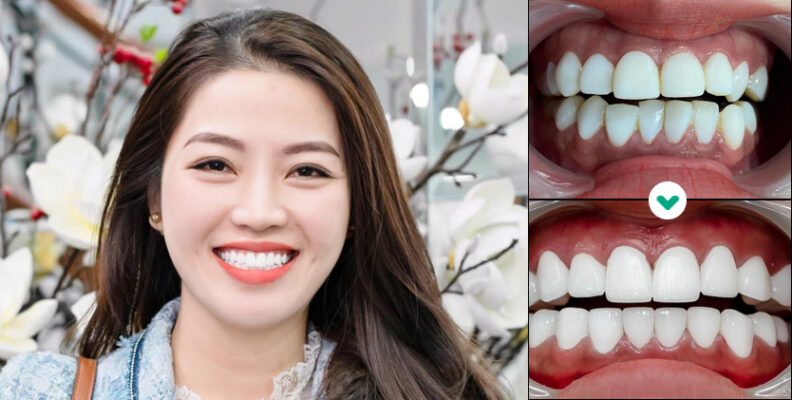 48H bọc răng sứ cao cấp Đức - Ăn nhai thoải mái, bền chắc trọn đời