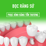 Những điều cần biết về răng sứ kim loại RĂNG SỨ