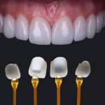 Ưu nhược điểm khi thực hiện dán sứ Veneer dan-su-veneer-1-1