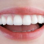 Những điều cần biết về bọc răng sứ toàn hàm lam-rang-su-tham-my-venus-tang-ngay-10-000-000vnd-16-rang-4