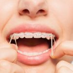 Hướng Dẫn Đeo Thun Liên Hàm, Tự Thay Tại Nhà Đúng Cách nen-deo-chun-nieng-rang-it-nhat-20-gio-mot-ngay
